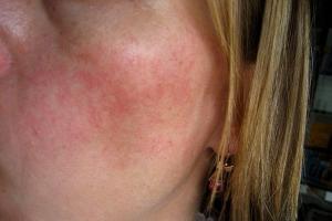 Příčiny a léčba růžovky na obličeji doma: jaký krém si vybrat Co pomůže s růžovkou