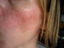 Príčiny a liečba rosacey na tvári doma: aký krém si vybrať Čo pomôže s rosaceou