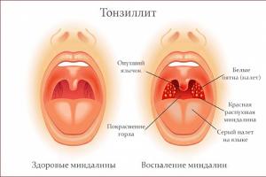 Faringita: fotografii, simptome, diagnostic și tratament Cum să tratezi partea din spate a gâtului